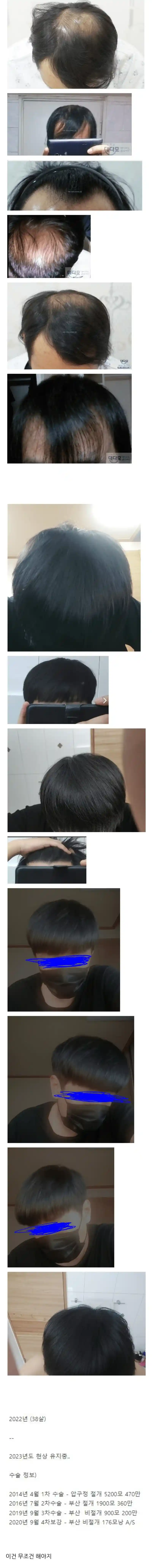 모발이식에 천만원 투자한 결과물