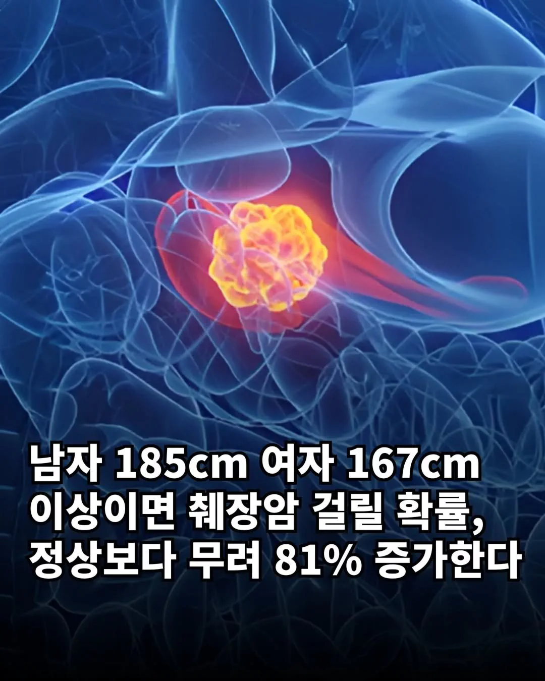 남들보다 췌장암 걸릴 확률 높은 사람 특징.jpg