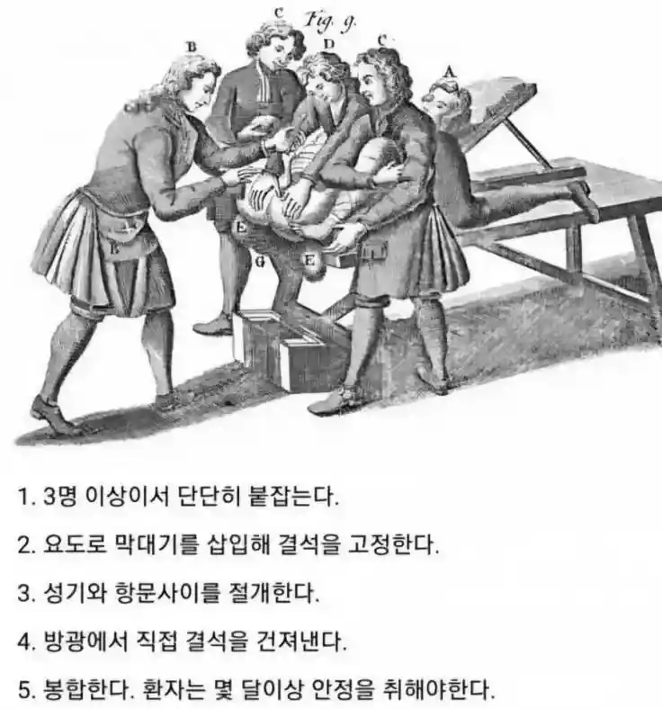 고문수준이었던 중세시대 요로결석 치료법