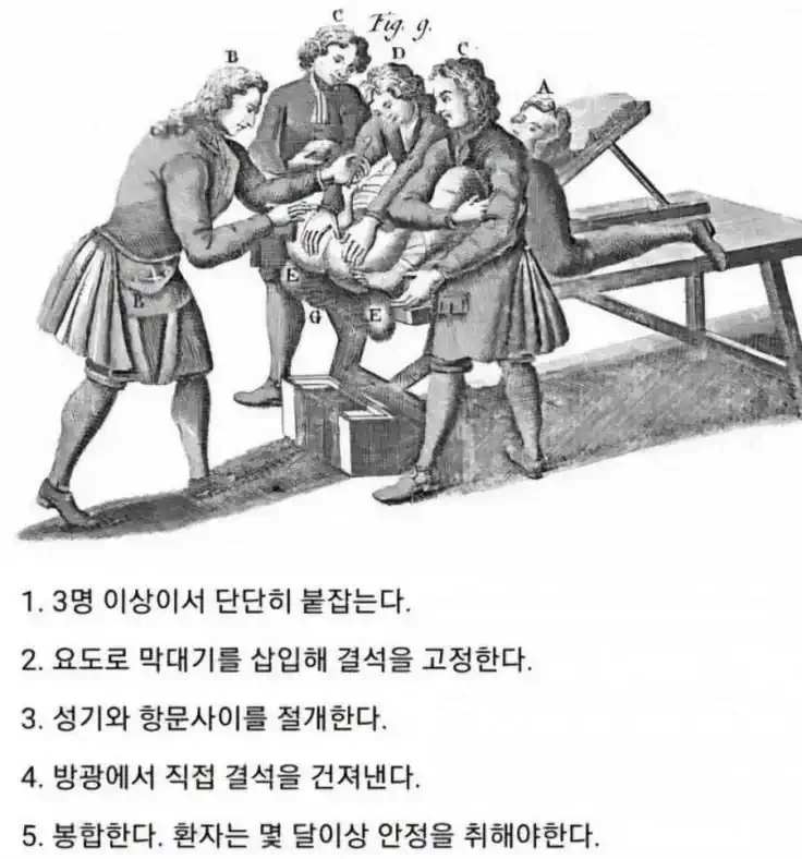 보기만 해도 아픈 18세기 요로결석 치료법.jpg