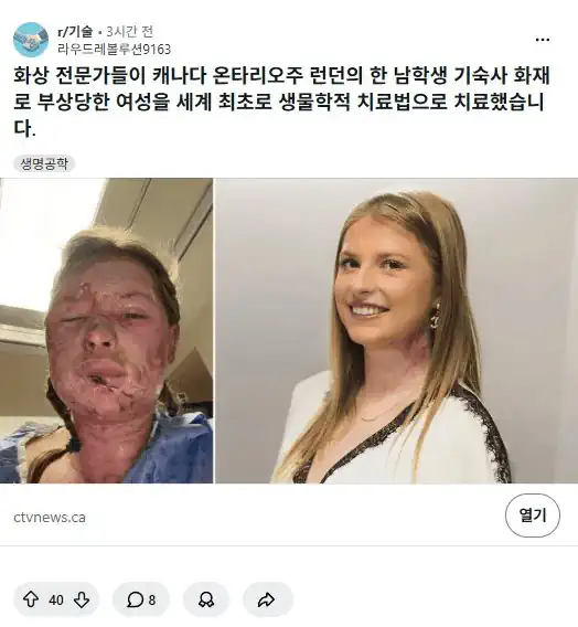 엄청나게 발전한 화상치료 최신 기술