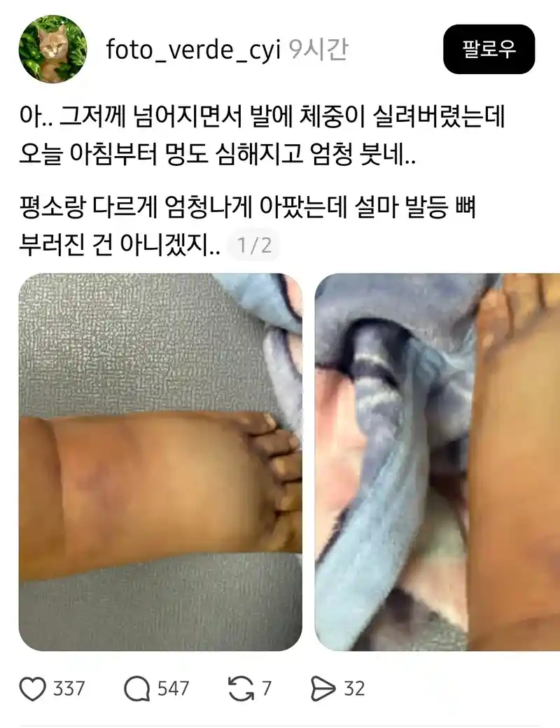 그제 넘어졌는데 발이 너무 아픔