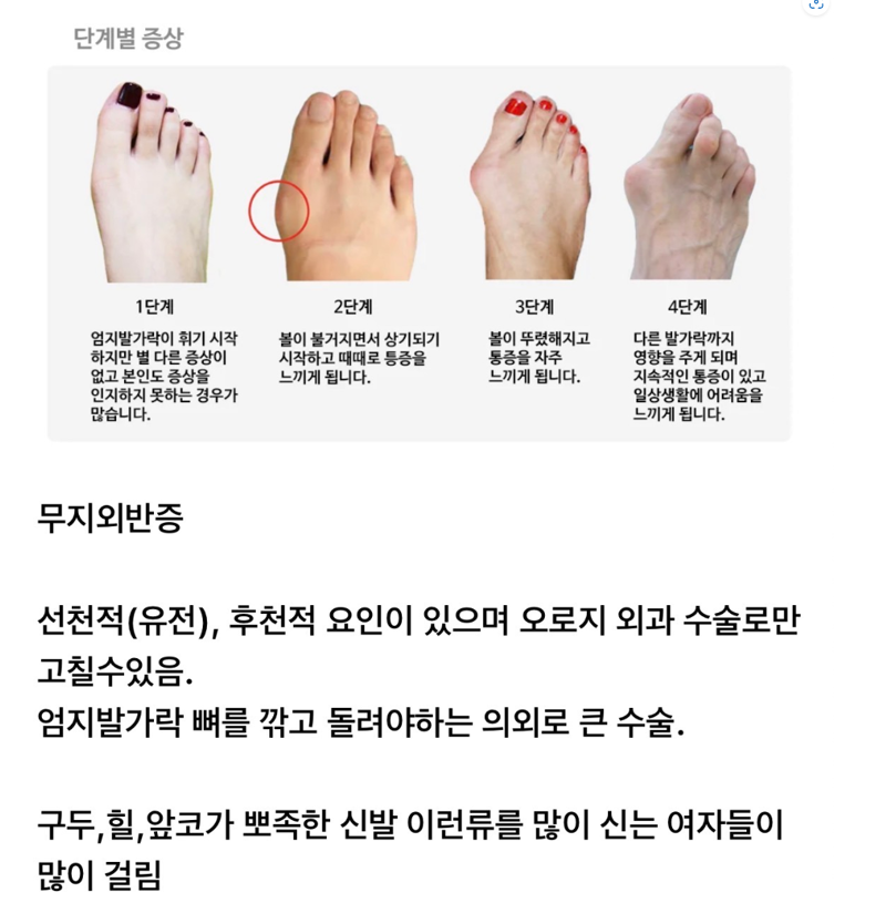 여자들이 많이 걸리는 발가락 질환