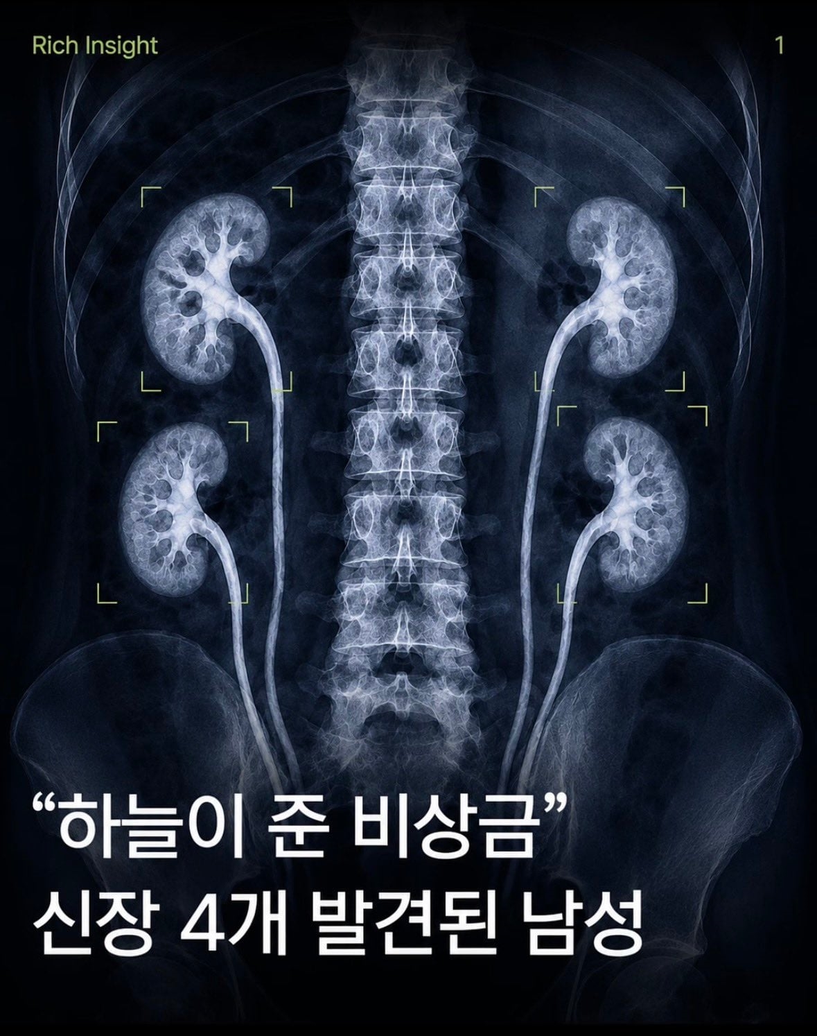 “하늘이 준 비상금” 신장 4개 발견된 남성
