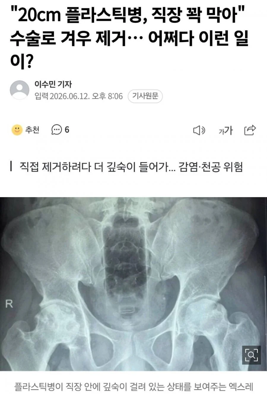 직장에 20cm 플라스틱병이 박힌 남자ㄷㄷ
