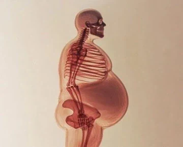 고도비만환자가 허리디스크를 달고 사는 이유.jpg