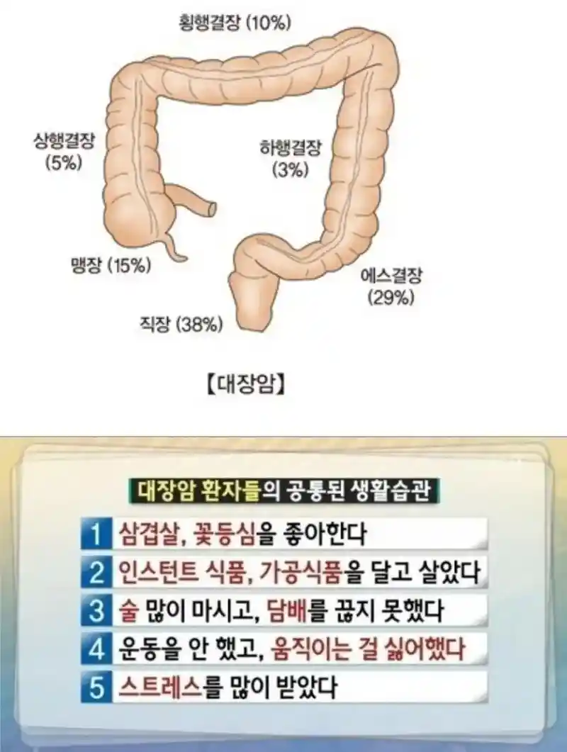 대장암 환자들의 공통된 습관
