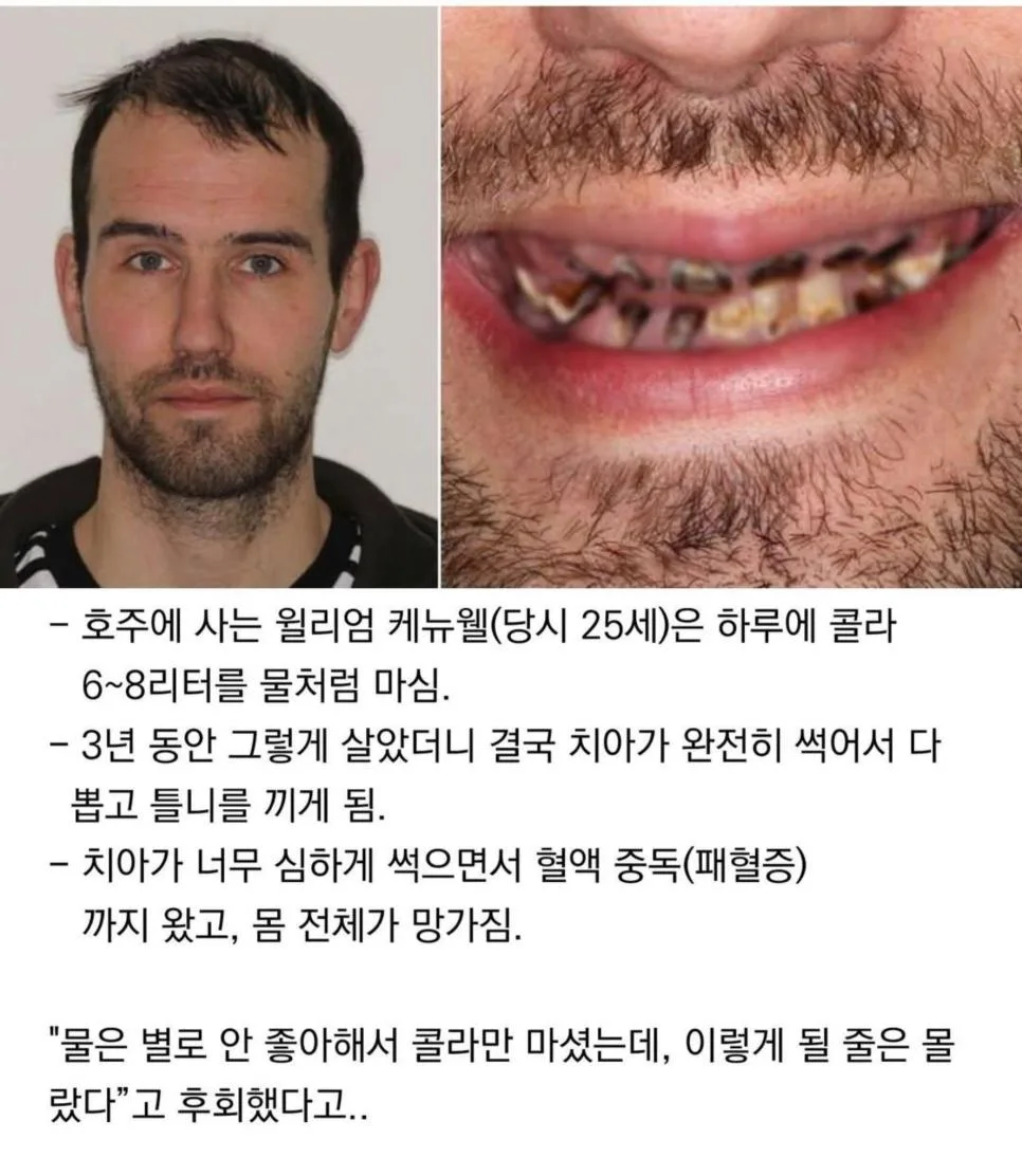 3년간 콜라먹은 남자 최후