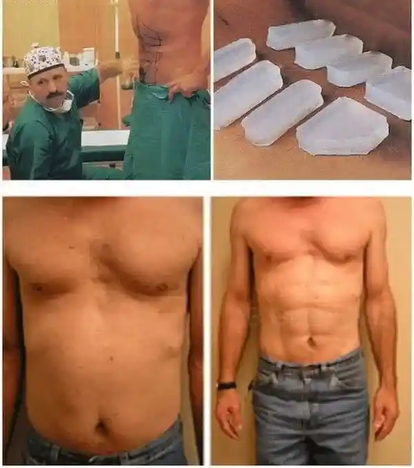 인공 복근 수술