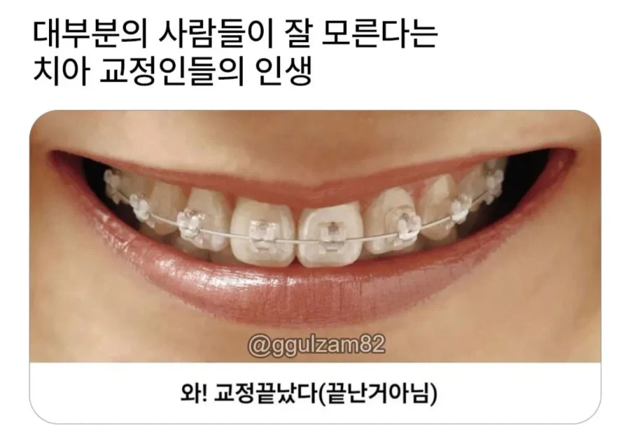 교정 안한 사람들은 모른다는 치아 교정인의 인생.jpg